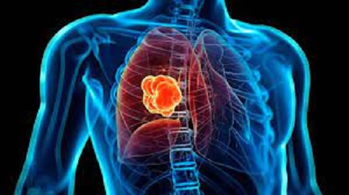 el oncológo trata diferentes tipos de cáncer el oncológo trata diferentes tipos de cáncer